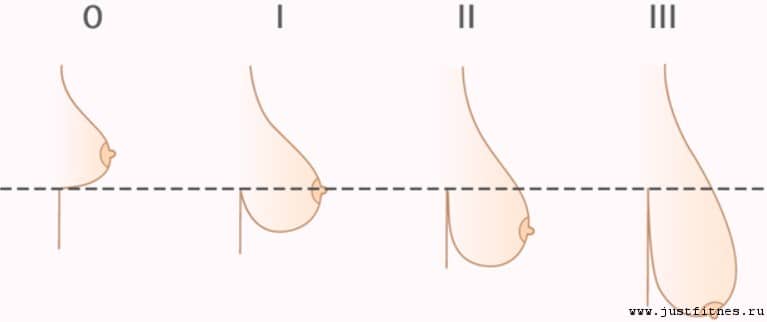 причины обвисания груди